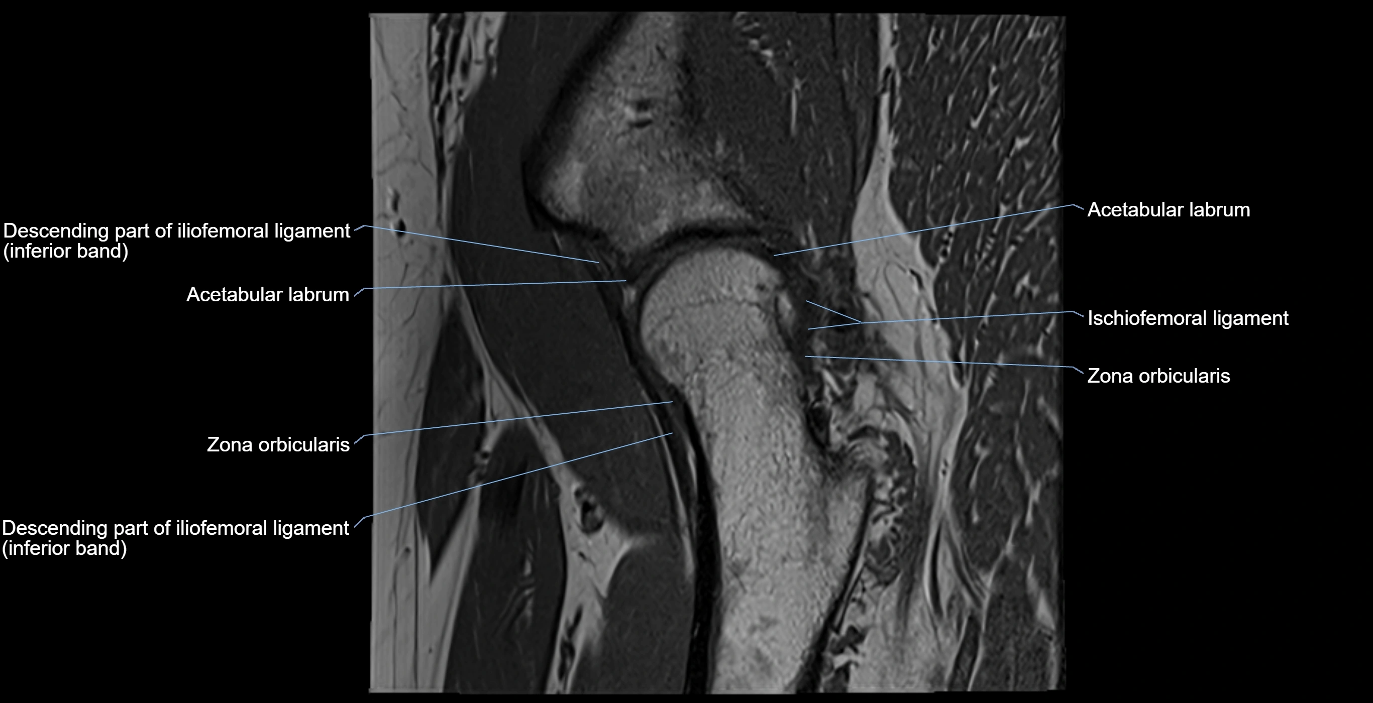MRI Hip ligaments sagittal cross sectional anatomy 3T  radiology  image-img-00001-00014.webp
